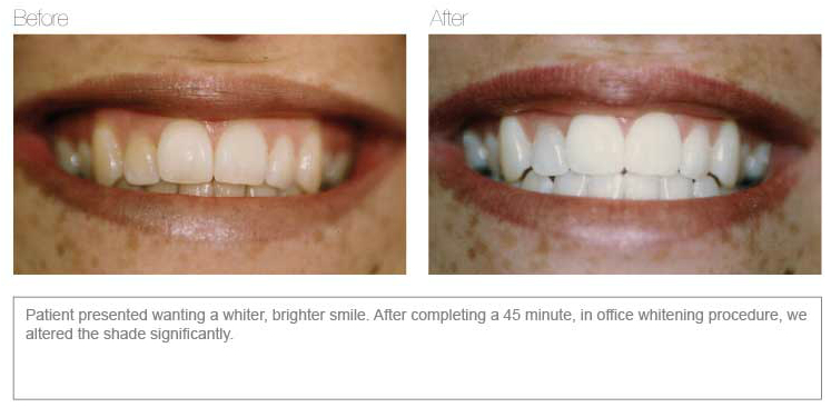 Teeth Whitening Before and After | Dentist Melbourne