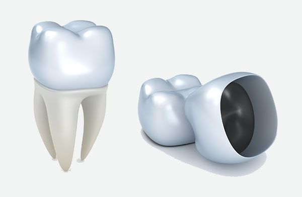 Q1 Dental Dental Crowns | Dentist Melbourne