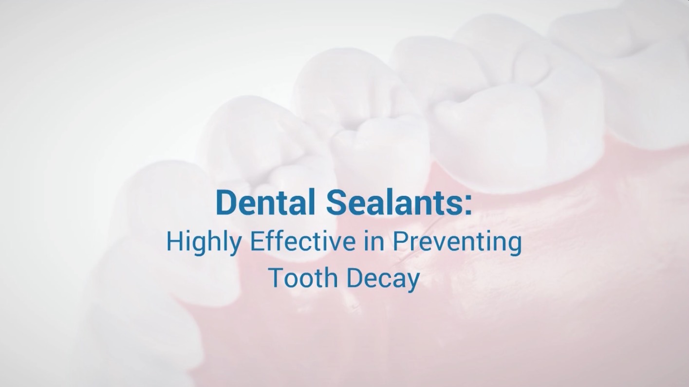 Dental Sealants- Highly Effective in Preventing Tooth Decay