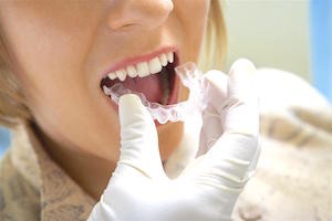 Adult Braces Youre Never Too Old for a Straighter Smile | Melbourne - Dentist