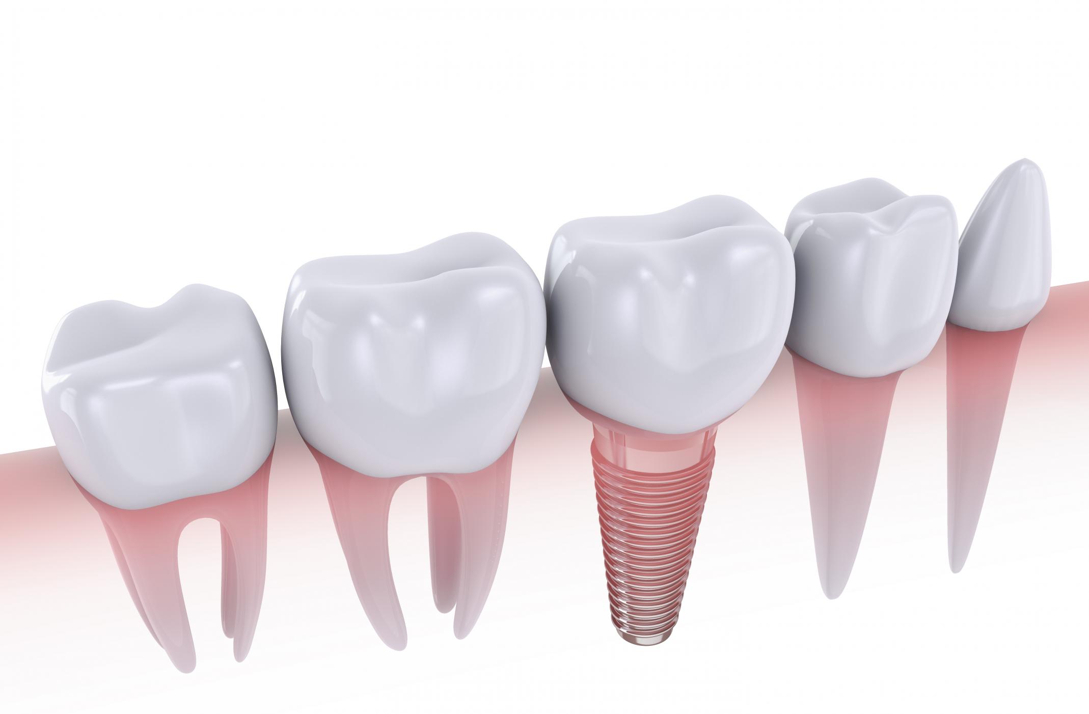 Melbourne Dentist Trivia Top 5 Myths about Dental Implants