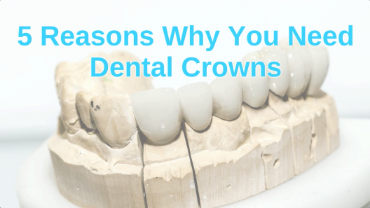 melbourne-dentist-tips-5-reasons-why-you-need-dental-crowns
